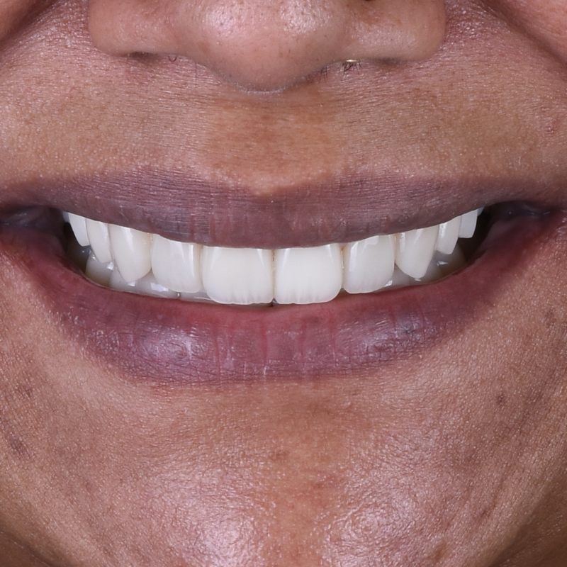 Close-up of a patient's smile after porcelain veneer treatment