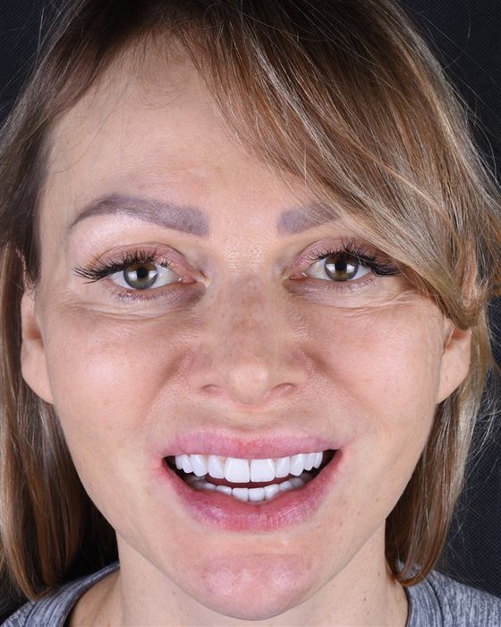 Patient's smile after porcelain veneer treatment: natural, symmetrical smile