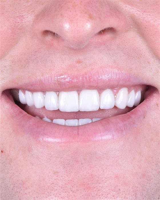 Close-up of a patient's smile after porcelain veneer treatment