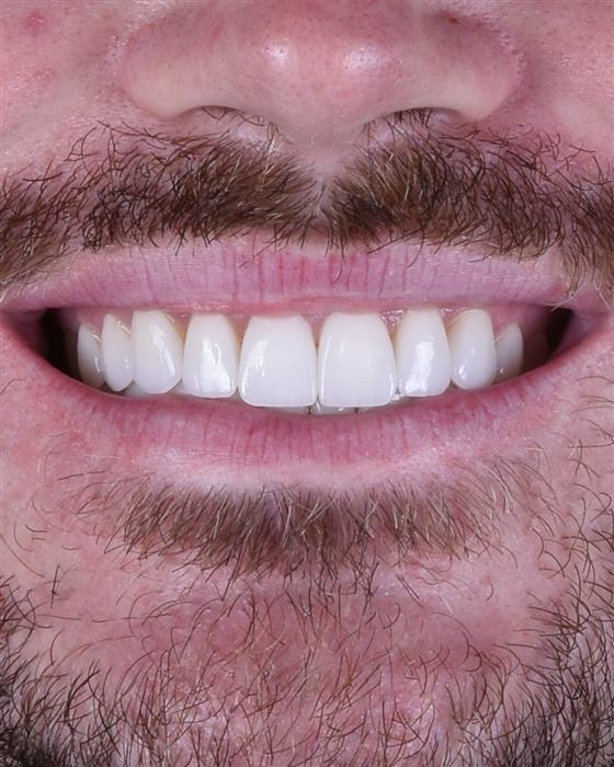 Close-up of a patient's smile after porcelain veneer treatment
