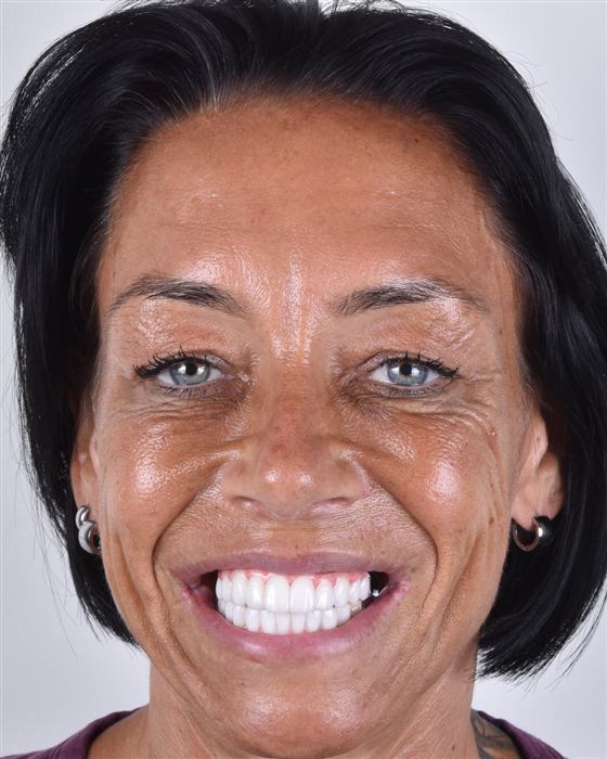 Patient's smile after porcelain veneer treatment, refined and balanced
