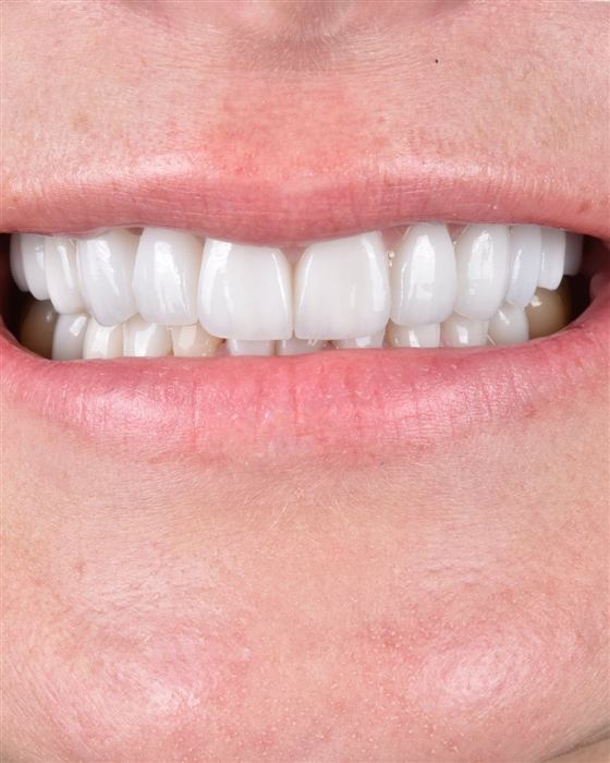Close-up of a patient's smile after porcelain veneer treatment