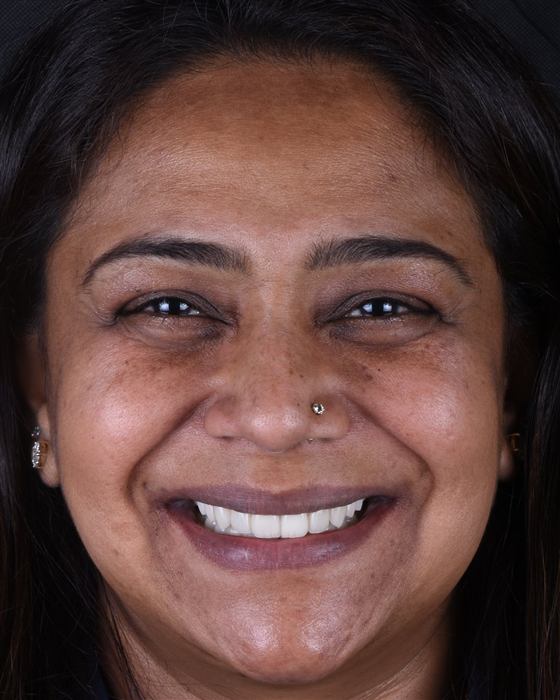 Patient's smile after porcelain veneer treatment, bright and even