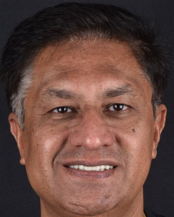 Patient's smile after porcelain veneer treatment, confident and natural