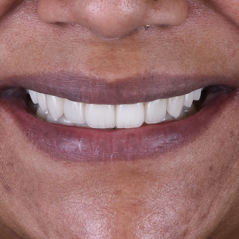 Close-up of a patient's smile after porcelain veneer treatment