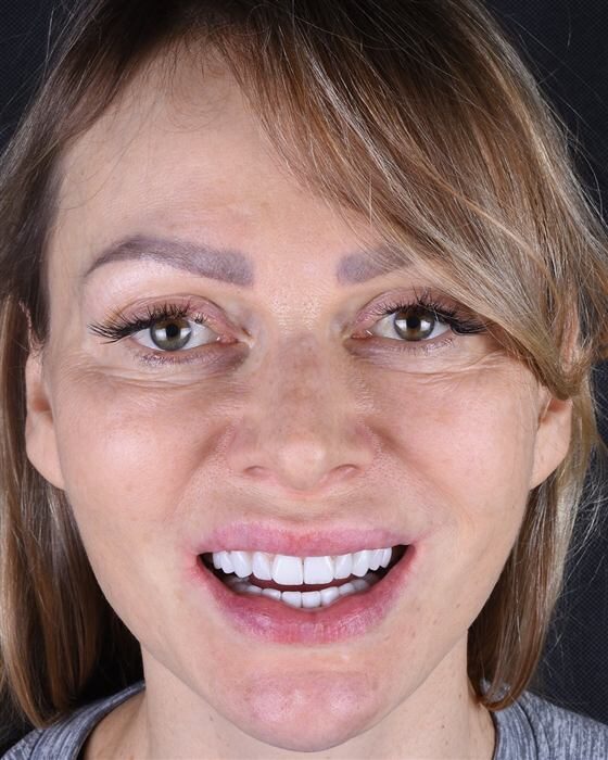Patient's smile after porcelain veneer treatment: natural, symmetrical smile