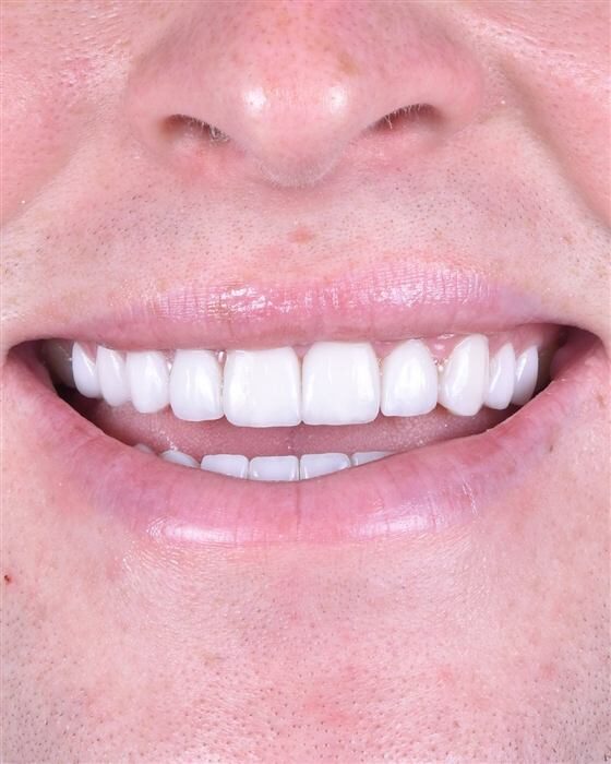Close-up of a patient's smile after porcelain veneer treatment