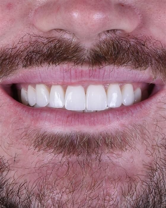 Close-up of a patient's smile after porcelain veneer treatment