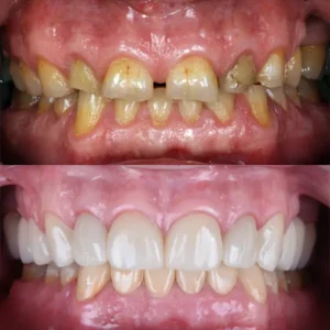 full mouth rehabilitation