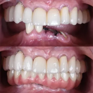 all on 4 implants