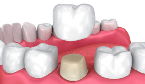 dental crown