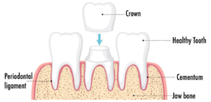 dental crown