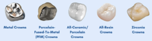 types of dental crowns