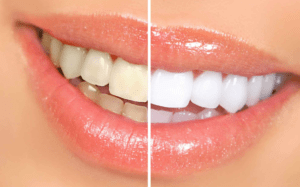 teeth whitening before and after