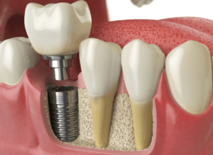 dental implant