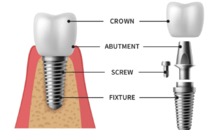 dental implant components