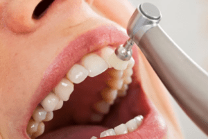 dental cleaning